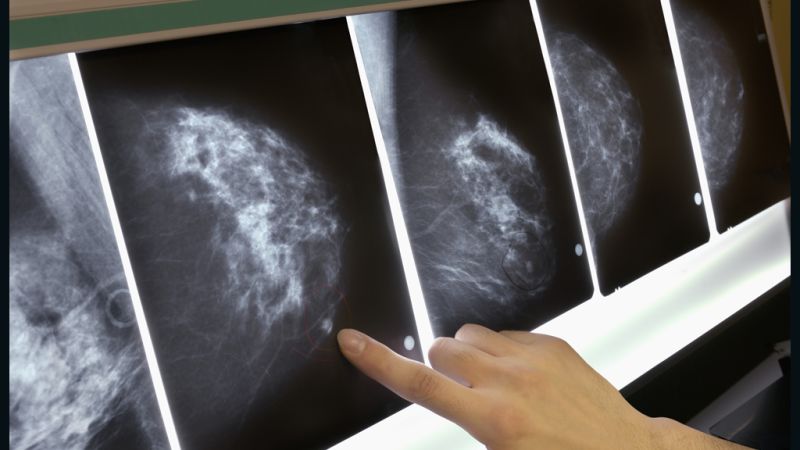 breast-cancer-surgery-mastectomy