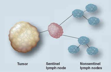 sentinel-lymph-node-biopsy-in-breast-cancer