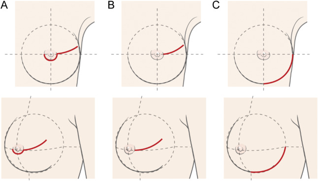 breast-mastectomy-surgery