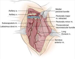 Axillary Lymph Node Dissection