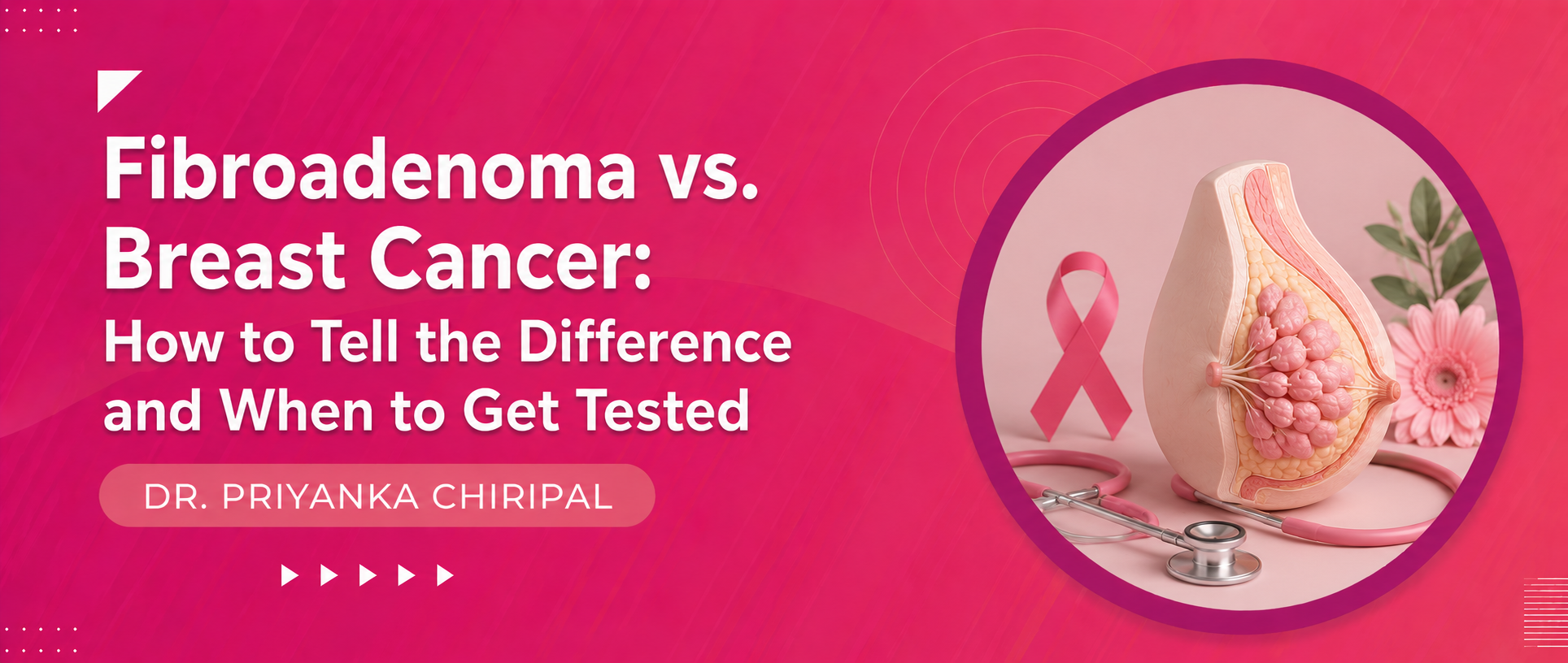 Fibroadenoma vs. Breast Cancer: How to Tell the Difference and When to Get Tested