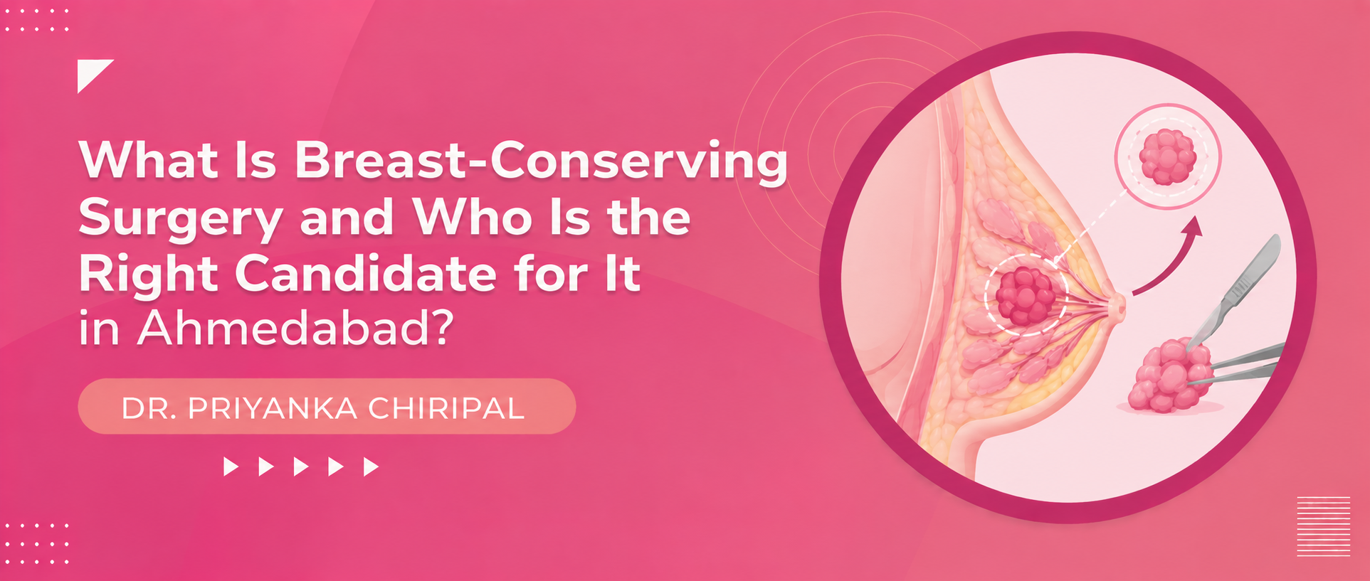 What Is Breast-Conserving Surgery and Who Is the Right Candidate for It in Ahmedabad?
