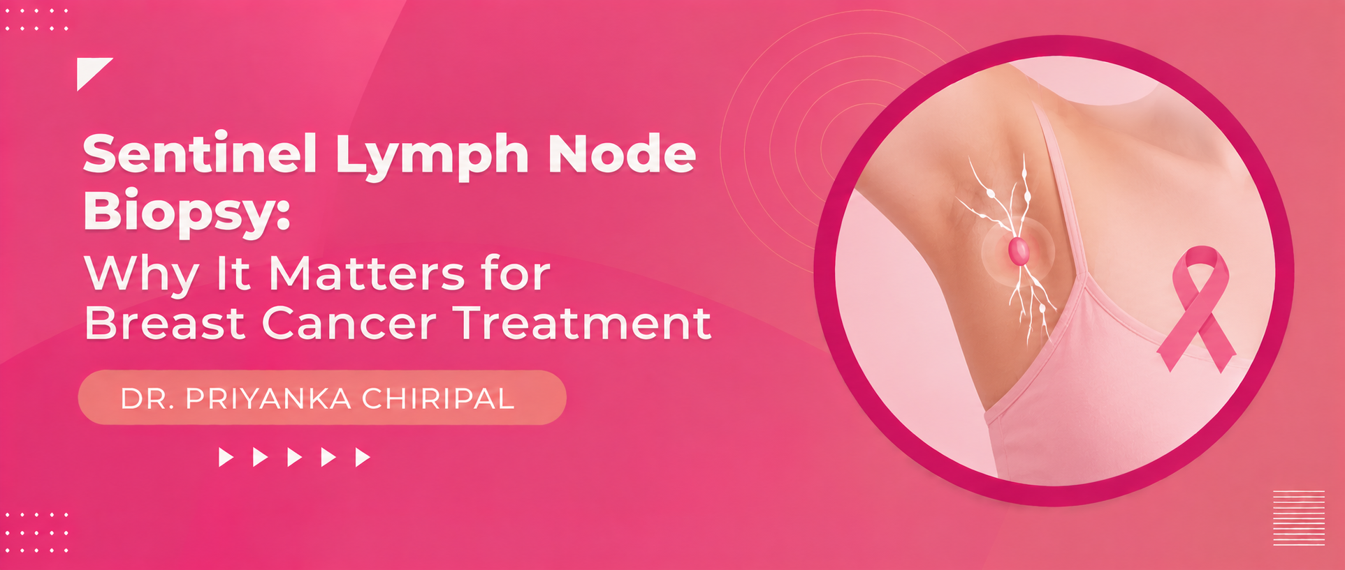 Sentinel Lymph Node Biopsy: Why It Matters for Breast Cancer Treatment